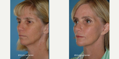 Facelift before and after photo