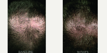 Hair Loss Treatment before and after photo