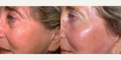 Laser Resurfacing before and after photo