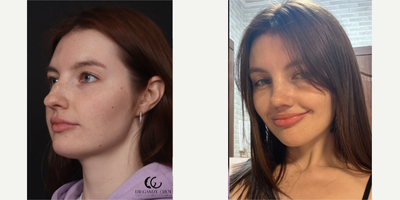 Rhinoplasty before and after photo
