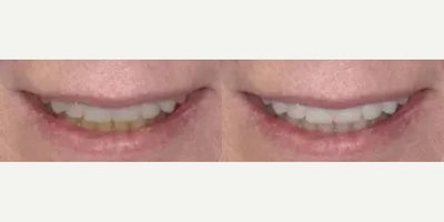 Smile Makeover before and after photo