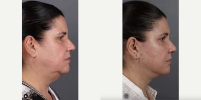 Facial Fat Transfer before and after photo