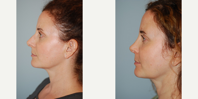 Rhinoplasty before and after photo