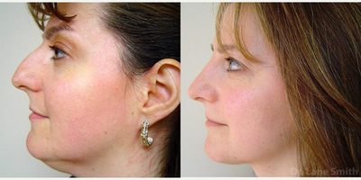 Rhinoplasty before and after photo