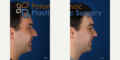 Septoplasty before and after photo