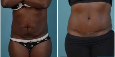 Tummy Tuck before and after photo