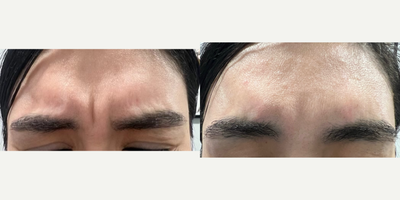 Botox before and after photo