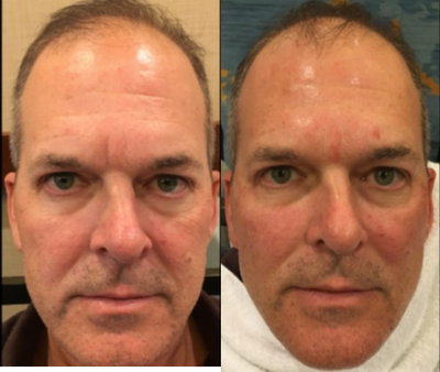 Cheek Augmentation before and after photo