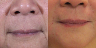 Dermal Fillers before and after photo