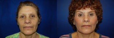 Facelift before and after photo