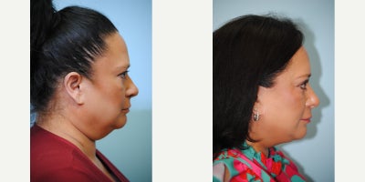 Facelift before and after photo