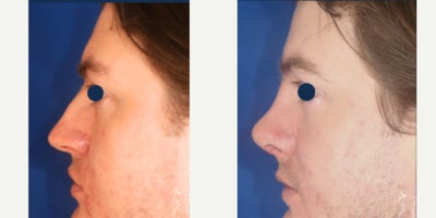 Rhinoplasty before and after photo