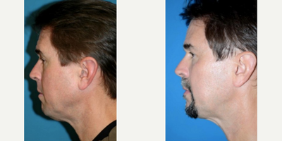 Sculptra before and after photo