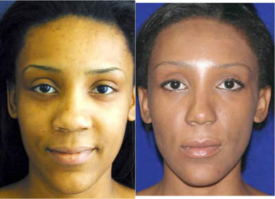 African American Rhinoplasty before and after photo