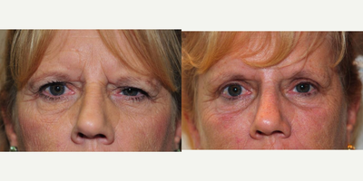 Brow Lift before and after photo