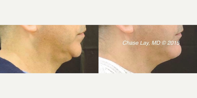 Chin Implant before and after photo