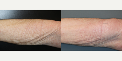 CO2 Laser before and after photo