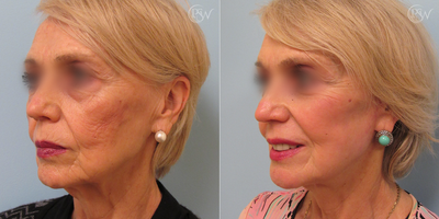 Facelift before and after photo