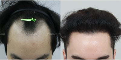 FUE Hair Transplant before and after photo