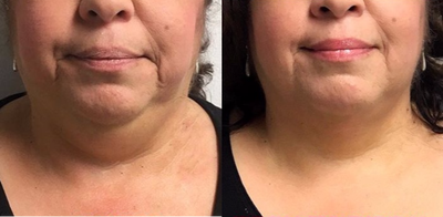 Kybella before and after photo