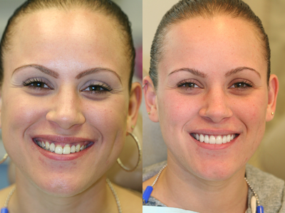 Porcelain Veneers before and after photo