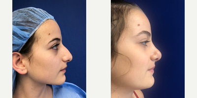 Rhinoplasty before and after photo