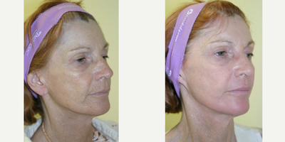 ActiveFX before and after photo