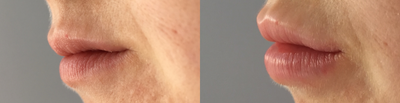 Dermal Fillers before and after photo