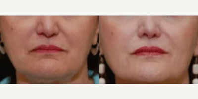 Dermal Fillers before and after photo