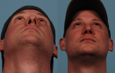 Rhinoplasty before and after photo