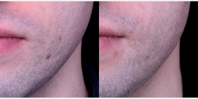 Vbeam before and after photo
