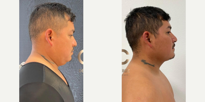 FaceTite before and after photo