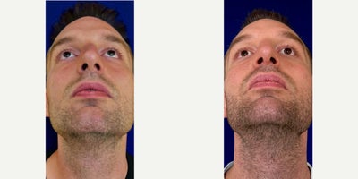 Rhinoplasty before and after photo