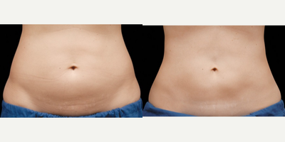 CoolSculpting before and after photo
