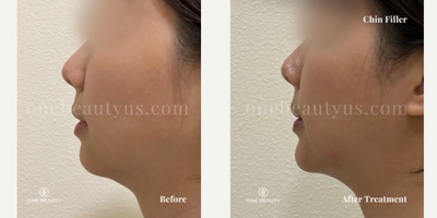 Juvederm before and after photo