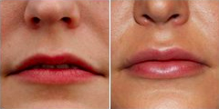 Lip Fillers before and after photo