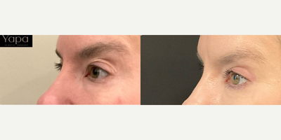 Brow Lift before and after photo