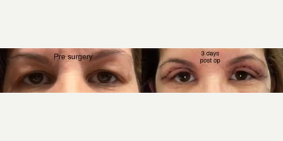 Eyelid Surgery before and after photo