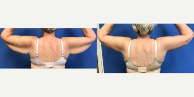 Liposuction before and after photo