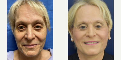 Mini Facelift before and after photo