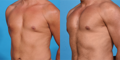 Pec Implants before and after photo