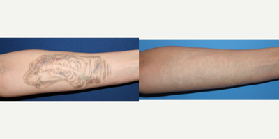 Scar Removal before and after photo