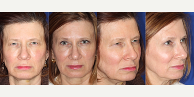 Eyelid Surgery before and after photo