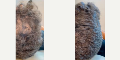 Hair Loss Treatment before and after photo