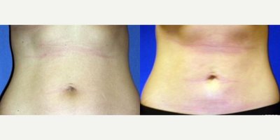 Liposuction before and after photo