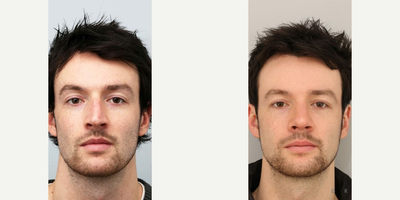 Septoplasty before and after photo