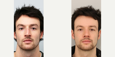 Septoplasty before and after photo