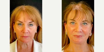Deep Plane Facelift before and after photo
