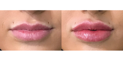 Dermal Fillers before and after photo