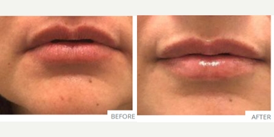 Dermal Fillers before and after photo